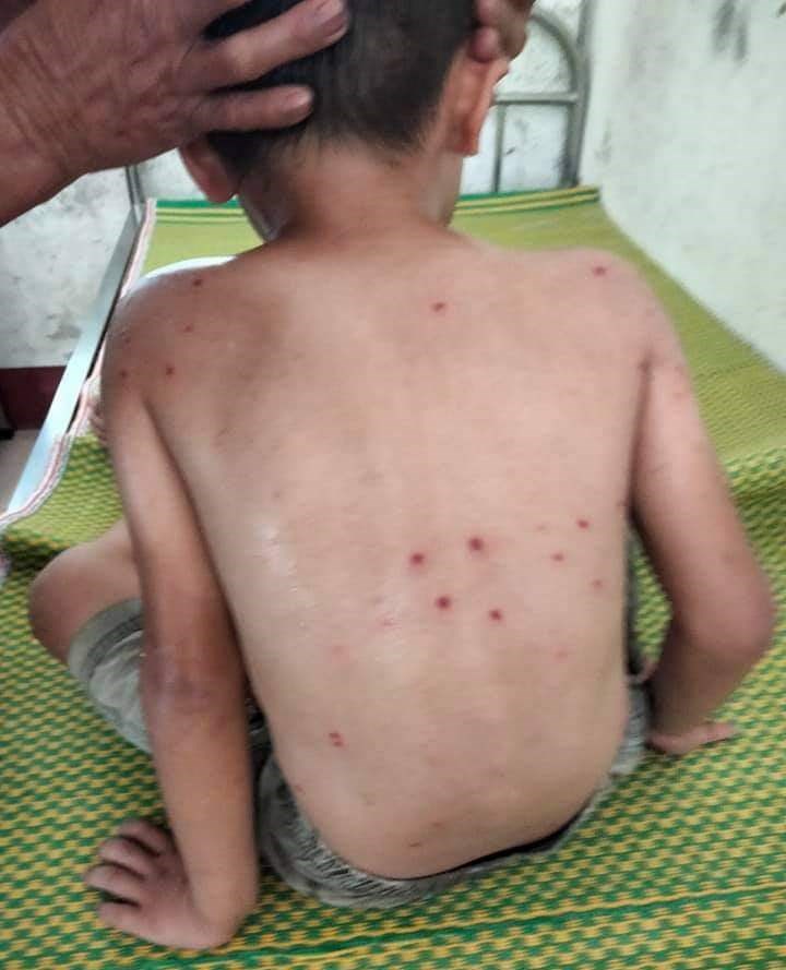 Cháu bé 5 tuổi ở Quảng Bình phải đi cấp cứu vì bị đàn ong vò vẽ đốt - ảnh 1