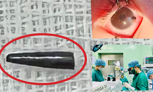 Phẫu thuật thành công bé trai bị ruột bút chì xuyên thủng nhãn cầu - Anh 1