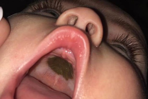 Người mẹ bối rối khi phát hiện ra vết đen khổng lồ trong miệng con gái nhỏ - Anh 2