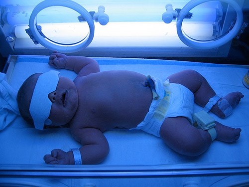 Chủ quan với bệnh vàng da có thể dẫn đến bại não ở trẻ sơ sinh - Anh 1
