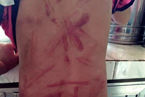 Xác minh thông tin cháu gái 6 tuổi ở Quảng Nam bị bà đánh thâm tím mình mẩy - Anh 2