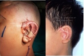 Việt Nam thực hiện thường quy kỹ thuật phẫu thuật tạo hình dị tật tai nhỏ tiên tiến nhất thế giới - Anh 1