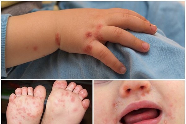 Không nên hoang mang việc thiếu thuốc điều trị bệnh tay chân miệng ở trẻ em - Anh 1