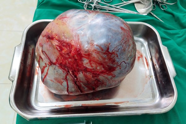 Phẫu thuật thành công khối u nang buồng trứng nặng 5,5kg - Anh 1