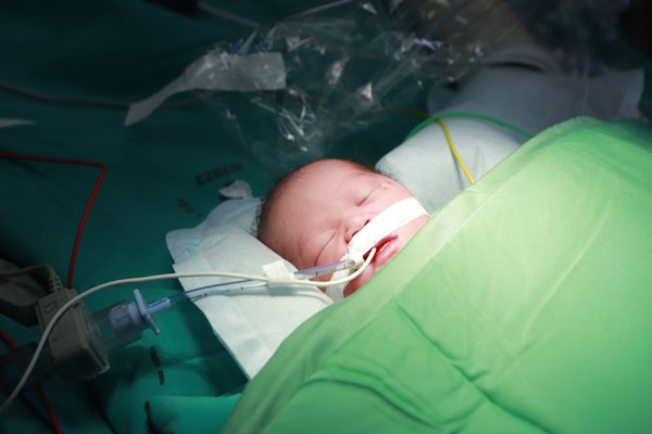 Lần đầu tiên phối hợp Sản - Nhi đặt máy tạo nhịp tim cho em bé khi vừa chào đời - Anh 3