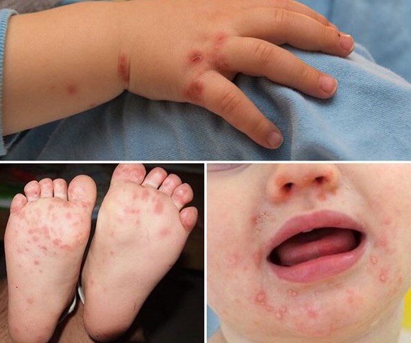 Số ca mắc tay chân miệng ở trẻ tại Quảng Ninh tăng đột biến - Anh 1