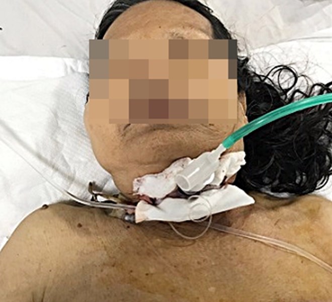 Quảng Nam: Cứu sống bệnh nhân bị đứt khí quản do ngã vào dao mổ gà - Anh 1
