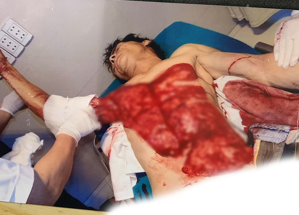 Phú Thọ: Hai tuần, 4 nạn nhân nguy kịch vì tai nạn máy bóc gỗ - ảnh 1